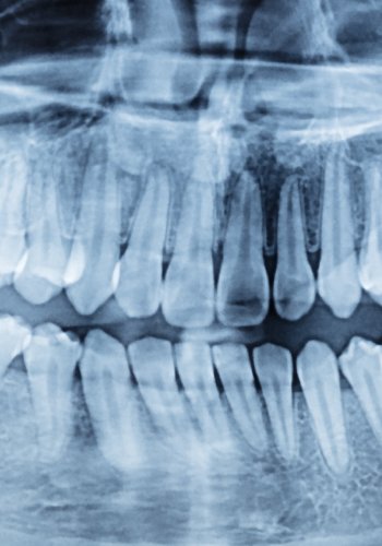 Como funciona Invisalign - Passo 3 Exames Clínicos